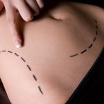 Qué, cómo y cuándo la microsucción lipolítica