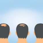 Evita estos factores que agravan la alopecia