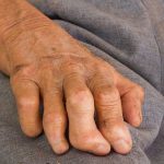 Los síntomas de la lepra tardan hasta más de 20 años en aparecer