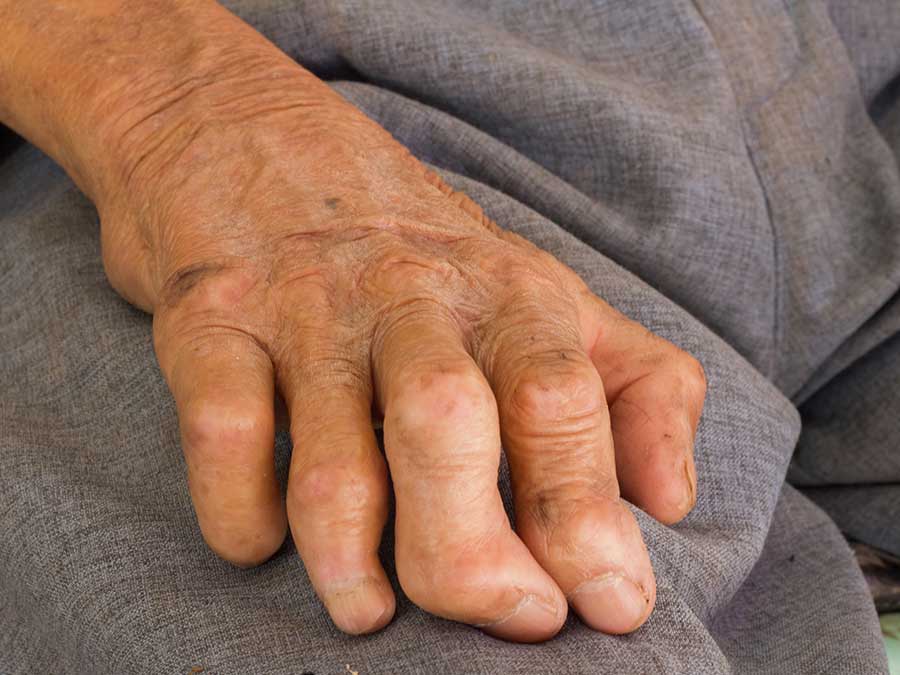 Los síntomas de la lepra tardan hasta más de 20 años en aparecer