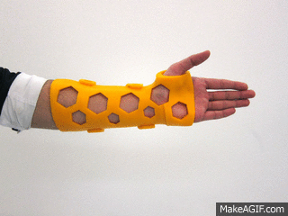 curar una fractura con impresión en 3D